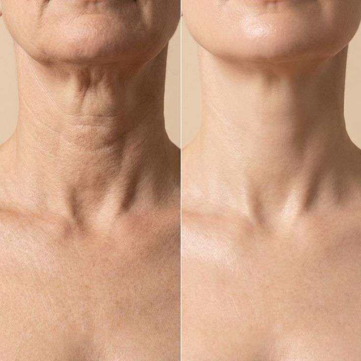 Home-use anti-aging device treating crepey neck skin with microcurrent and LED therapy