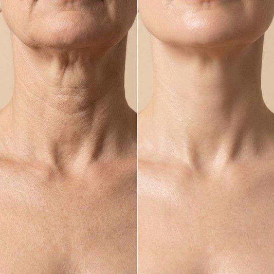 Home-use anti-aging device treating crepey neck skin with microcurrent and LED therapy
