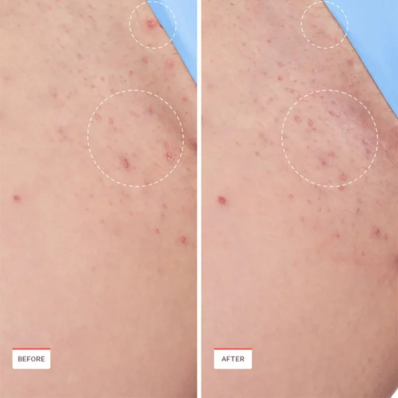 Solution To Endogenous Hair Soothing Ball Essence Anti Hair Inner Smooth Armpit Bikini Ingrown Hair