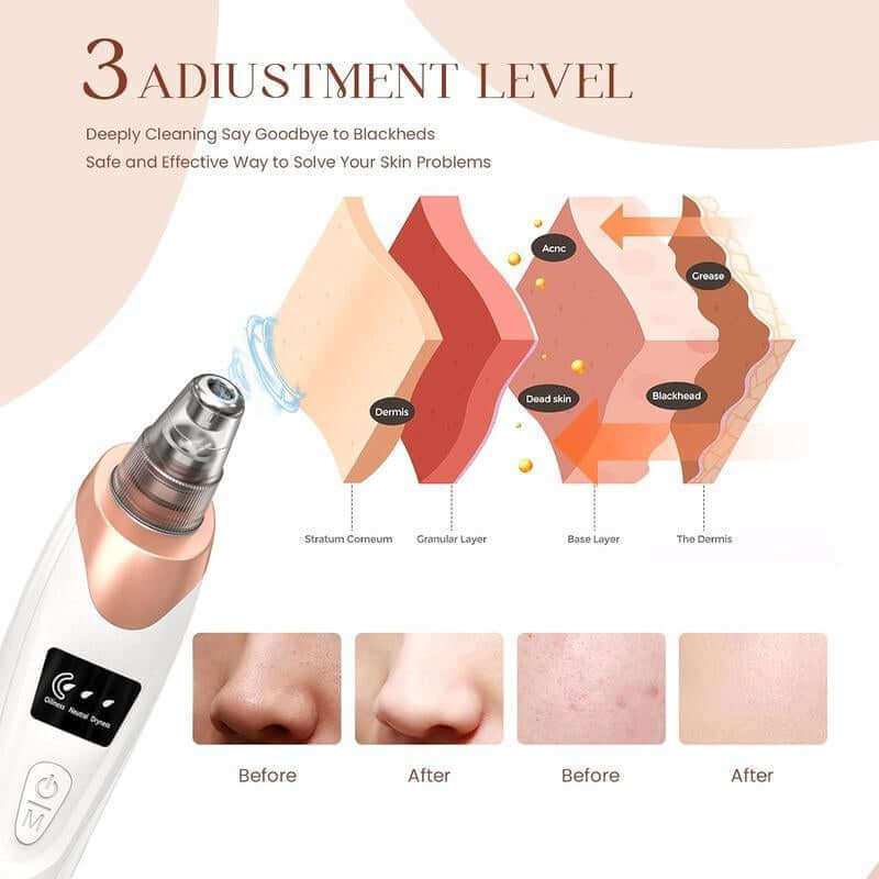 Pro Pore Vacuum Cleaner with USB rechargeable battery and multiple suction probes for effective blackhead removal